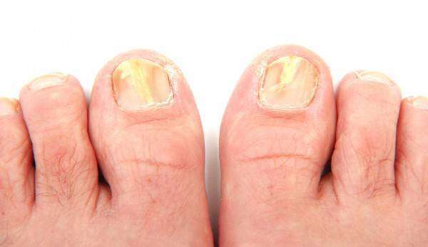depositphotos_10734833-stock-photo-toenails-infected-with-a-fungus.jpg