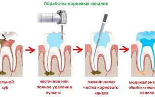 Коронально-апикальные методы для обработки корневых каналов