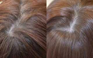 Эффективен ли шампунь Сульсена при выпадении волос?